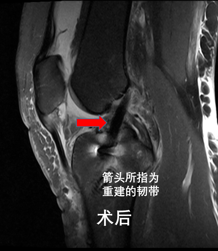 季后赛带伤作战！杰威接受右手韧带撕裂修复手术的简单介绍